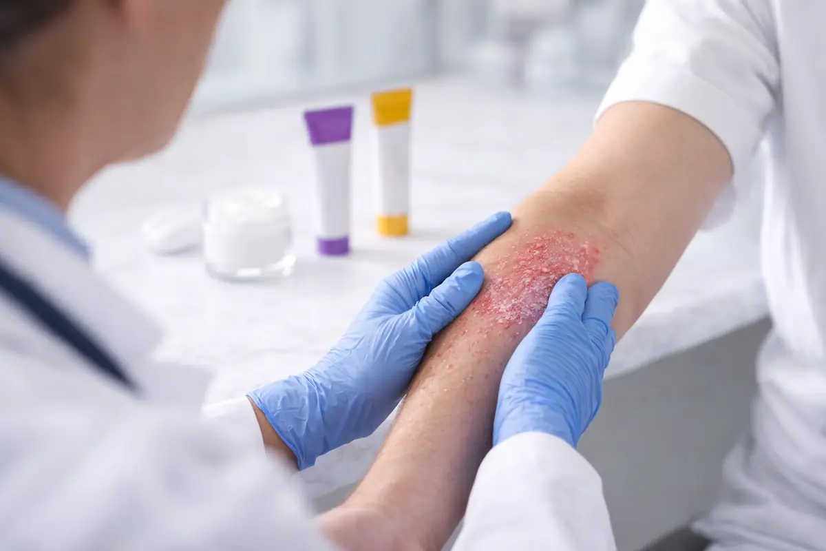 Dermatologo esamina lesione psoriasica del paziente